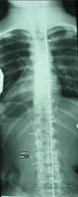 Rumpforthesenversorgung Röntgenbild mit Korsett